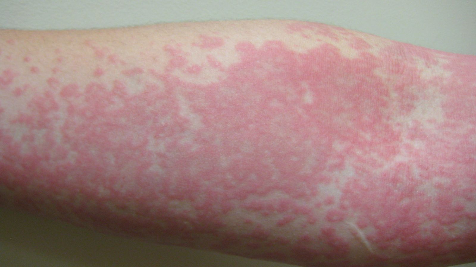 A hive-type rash, or urticaria, is among the three skin conditions that can be the only symptom of COVID-19. 